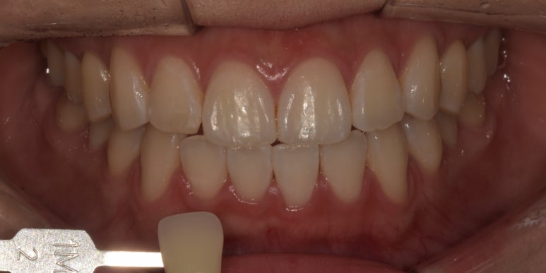 치과치아미백, 전후사진과 치료비용이 궁금하다면? 관련 이미지 8