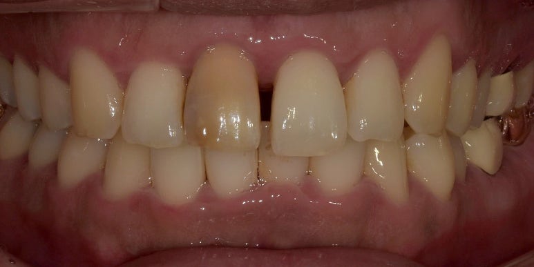 치간이개라미네이트, 벌어진 앞니 개선한 최신사례 관련 이미지 2