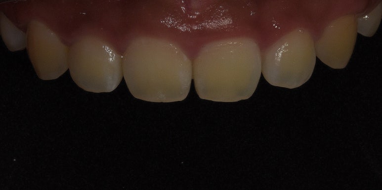 잇몸성형, OO해서 후회해요&hellip; 후회하는 이유는? 관련 이미지 9