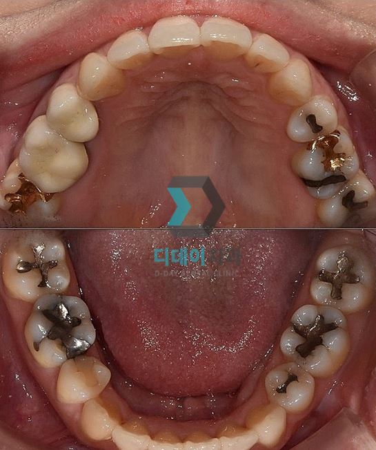 세라믹인레이장점과 단점 솔직하게 말씀드립니다 관련 이미지 2