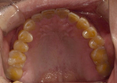 치아도 녹아내린다? 치아부식 원인과 치료방법은? 관련 이미지 3