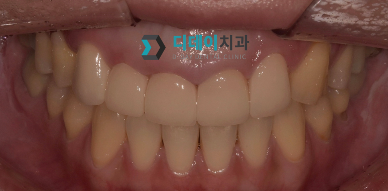 치아쪼개짐, 바로 치과 안가면 신경치료까지 갑니다 관련 이미지 4