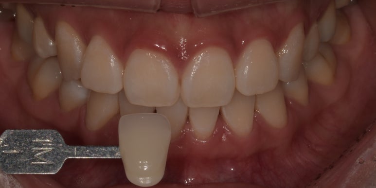 치과치아미백, 전후사진과 치료비용이 궁금하다면? 관련 이미지 4