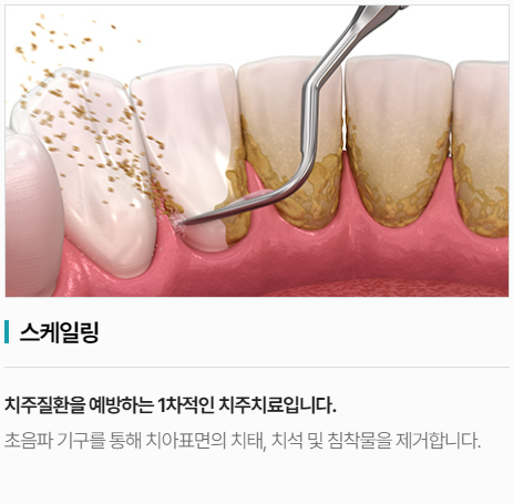 잇몸치료, 치과에서 꽁꽁 숨기는 치료라구요? 진실 알려드립니다. 관련 이미지 3