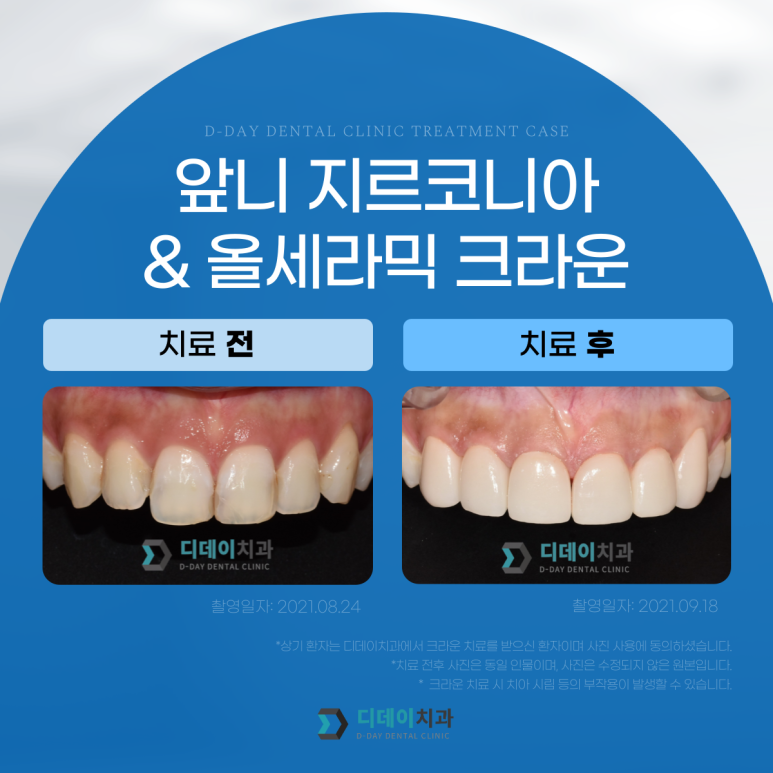 앞니크라운, 라미네이트 같이 하면 티날까? 사진으로 증명합니다. 관련 이미지 5