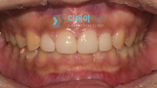 벌어진치아, 교정하지 않고 앞니틈새를 메우는 방법 관련 이미지 4