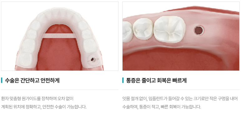 임플란트부작용 걱정? 이 글 보시면 걱정 안하셔도 됩니다. 관련 이미지 6