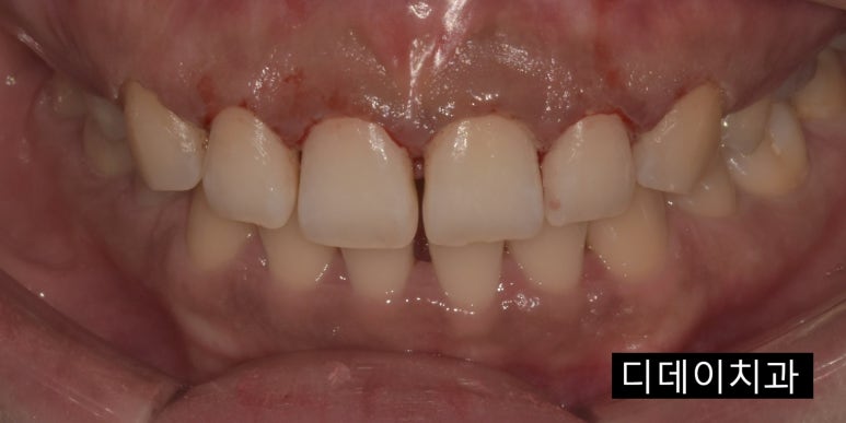 [진심인터뷰] &ldquo;잇몸성형, 안 할 이유가 1도 없어요&rdquo; 예비신부의 후기 관련 이미지 3