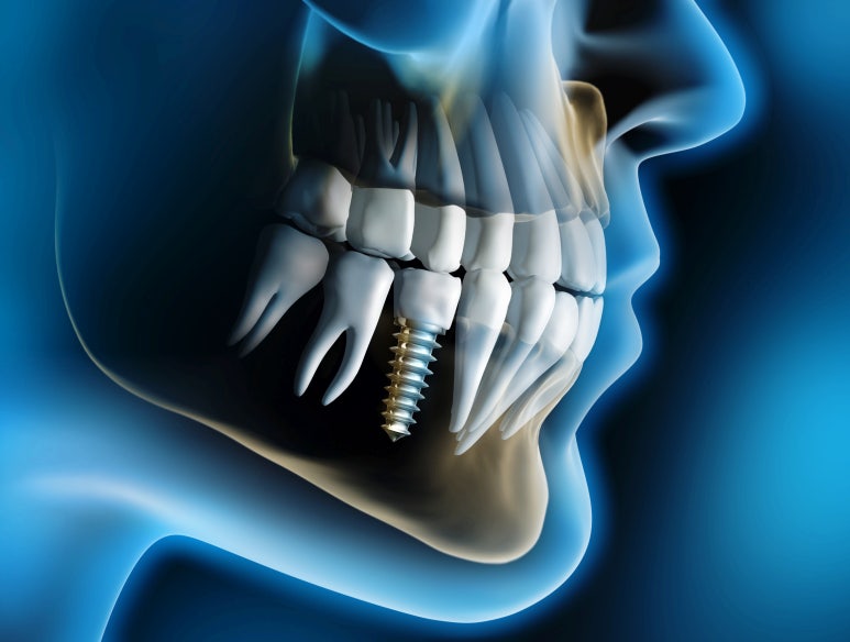 역삼/선릉/삼성 임플란트? 비용 통증 걱정되는 분들이라면 관련 이미지 5