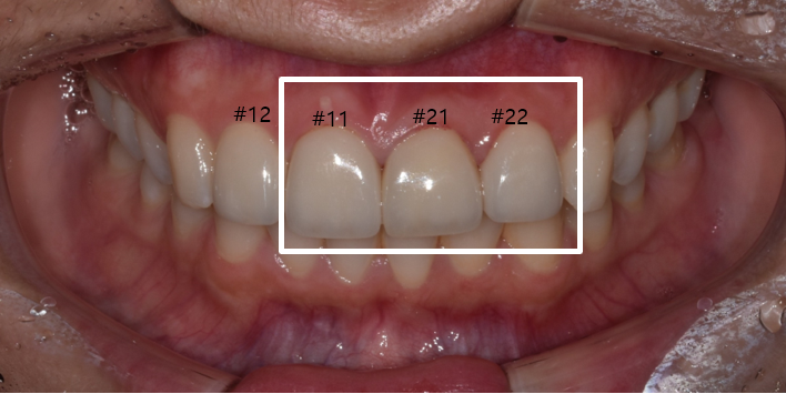 라미네이트올세라믹, 차이점과 치료사례까지 모두 공유합니다. 관련 이미지 8
