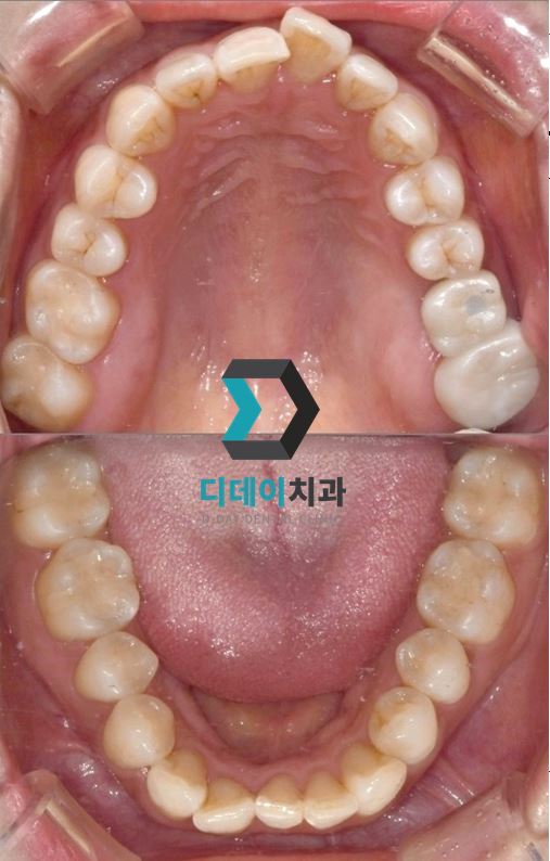 아말감교체, 꼭 해야하나요? 비용은 얼마인가요? 관련 이미지 9