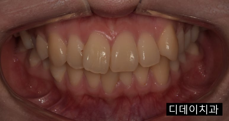 무삭제라미네이트 누구나 다 된다? 속지마세요. 관련 이미지 8