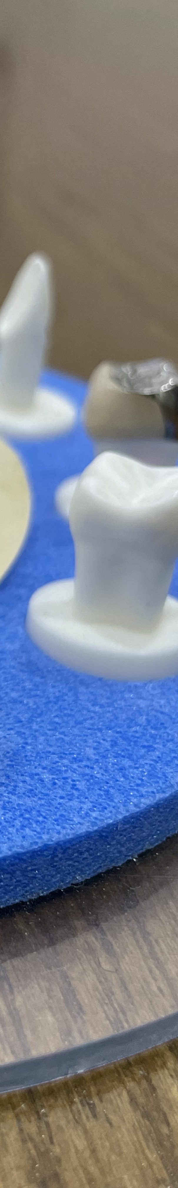 도곡동 충치치료,이에 까만 점이 보인다면? 관련 이미지 10