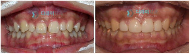 작은이빨, 왜소치? 치아 크기를 키우고 싶은 분만 <필독> 관련 이미지 15