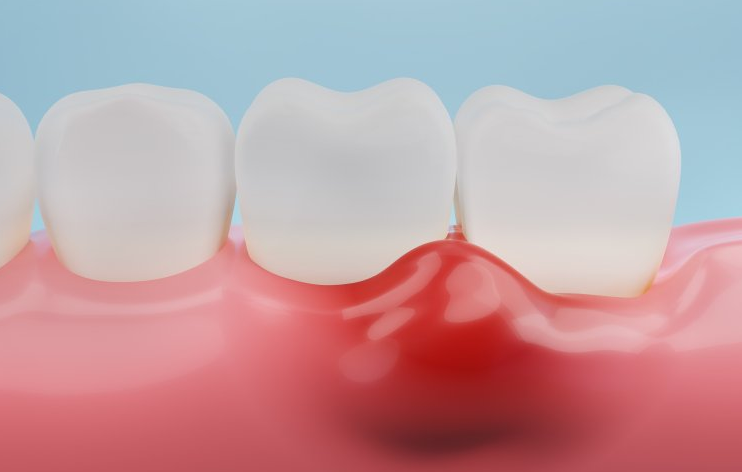 어금니잇몸물집, 방치하면 안 되는 이유 의사가 직접 설명합니다 관련 이미지 2