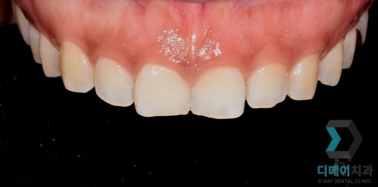 치아성형 종류, 비용, 장단점까지 완벽정리 관련 이미지 13