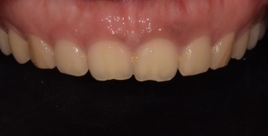 법랑질성형, 잇몸성형, 치아미백까지! 디데이치과 심미치료 총집합 치료사례 관련 이미지 7