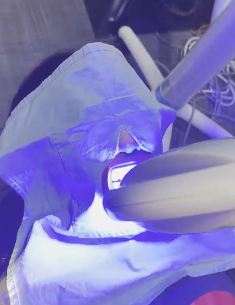 선릉역치아미백후기 보기 전에 관련 이미지 4