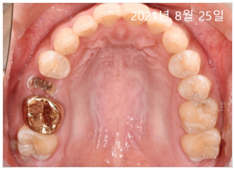 치과 보험 임플란트?전문의가 치료사례 보여드립니다. 관련 이미지 2