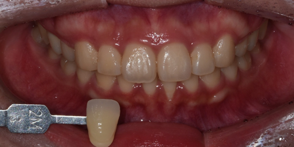 치아미백유지기간부터 종류, 주의사항까지 알려드립니다 관련 이미지 8