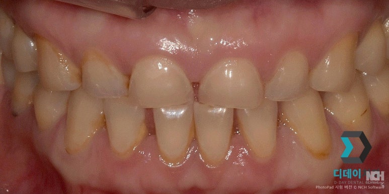 앞니살짝깨짐 이 1가지만 확인하면 치료 방향 결정됩니다 관련 이미지 7
