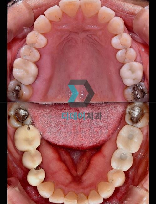 아말감교체, 꼭 해야하나요? 비용은 얼마인가요? 관련 이미지 4