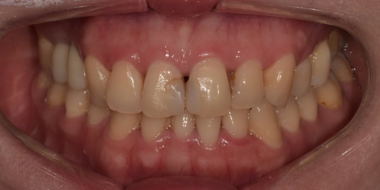 라미네이트후기, 닳아있고 변색된 치아 치료한 최신사례 관련 이미지 5