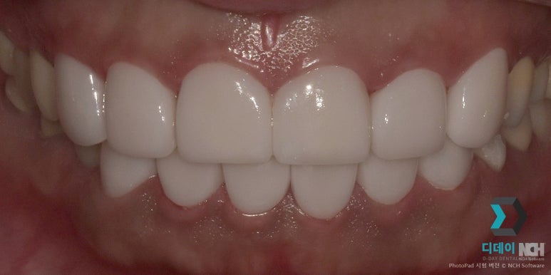 언주역라미네이트 잘하는 치과 특징 3가지 원장 작성 관련 이미지 5