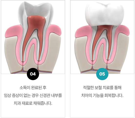 충치신경치료 그렇게 아픈가요? 신경치료통증 오해와 진실 관련 이미지 6