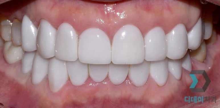 라미네이트교체, 재시술은 더 신중해야 하는 이유? 관련 이미지 4