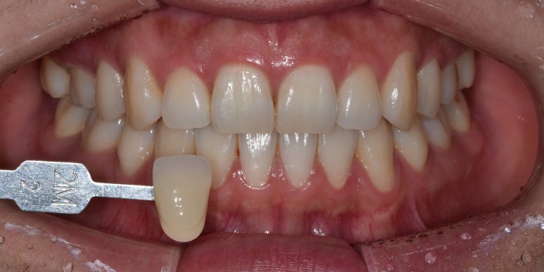 누렁니치아미백, 치료 사례로 보여드리는 개선 효과 관련 이미지 3