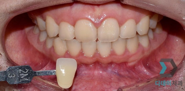 디데이치과에서 알려드리는 치아미백 관련 이미지 2
