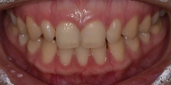 잇몸성형후기, 사례가 없어 고민하셨던 분만 관련 이미지 6