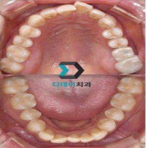 Why Does Acute Pulpitis Occur? The Answer Is Obvious. image 5