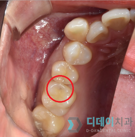 강남충치치료? 티 안나는 "인레이" 치료 사례 관련 이미지 5