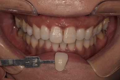 치아미백비용, 치과가 10배 비싼데도 시술하는 이유? 관련 이미지 2