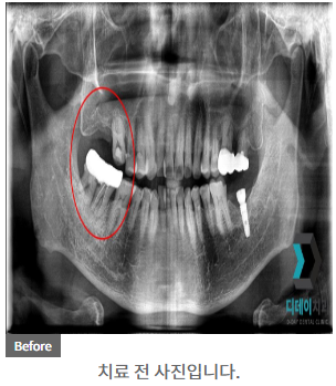 60대 이상 임플란트? 70대에도 할 수 있습니다. 관련 이미지 4