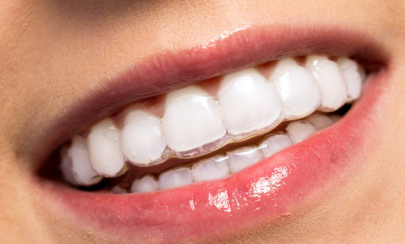 서울 투명교정 시작 전 알아야 하는 핵심사항들 관련 이미지 2