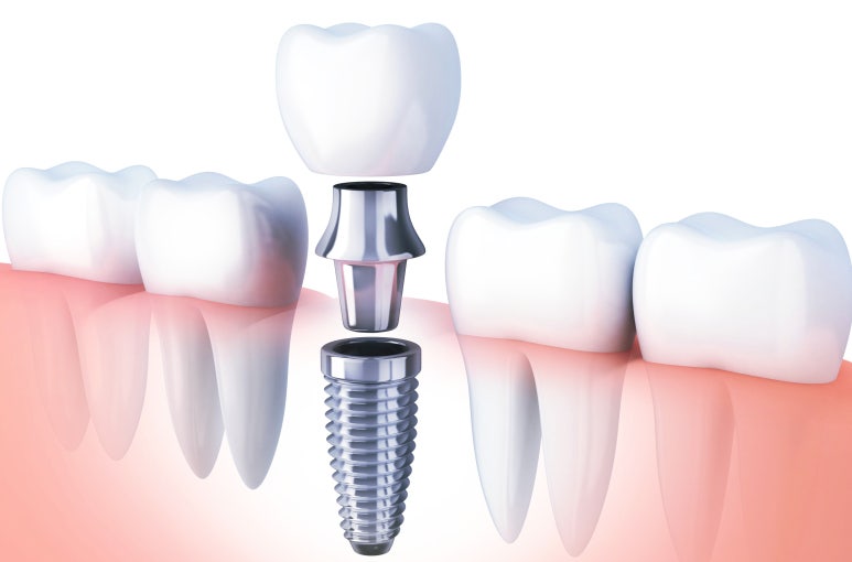 임플란트보증서? 현직 의사가 알려드립니다. 관련 이미지 1