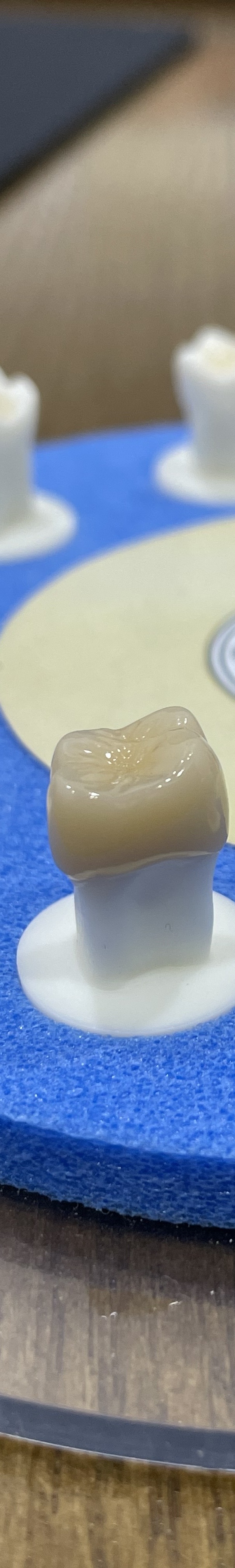 도곡동 충치치료,이에 까만 점이 보인다면? 관련 이미지 7