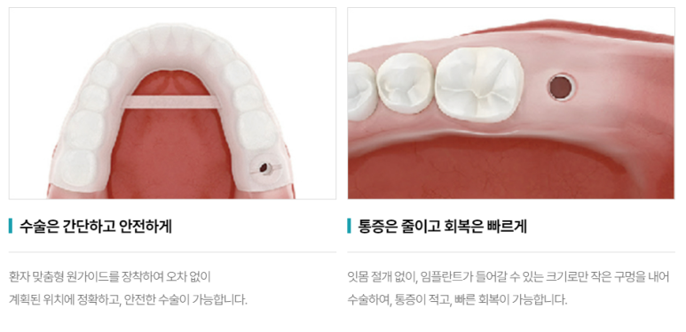 임플란트통증? 아플까봐 무서워서 시술 망설인다면 <필독> 관련 이미지 5