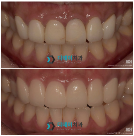 언주역치과추천 라미네이트, 자연치아 삭제량이 중요합니다 관련 이미지 7