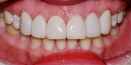 서울라미네이트? 전문의가 설명드립니다. 관련 이미지 3