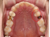 임플란트교체? 걱정되시는분들만 보세요. 관련 이미지 6