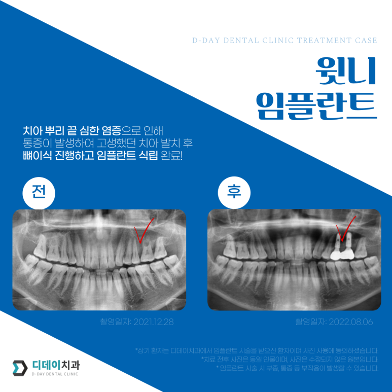 임플란트종류, 브랜드별로 무슨 차이인지 뭐가 좋은지 모르겠다면? 관련 이미지 5