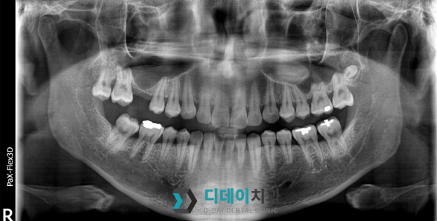 신논현역임플란트, 수술 경험 많은 의사가 알려주는 2가지 기준 관련 이미지 8