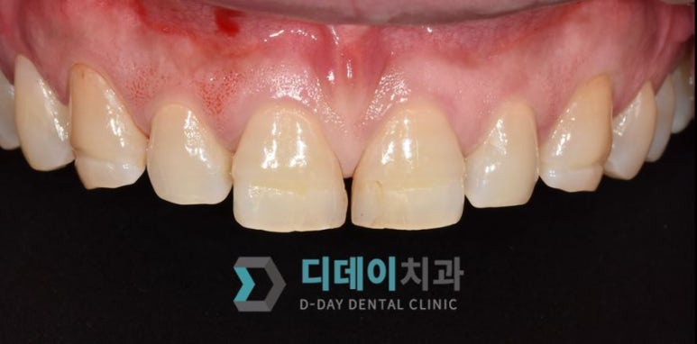 라미네이트후기, 치료사례만 모아 보여드립니다 관련 이미지 9