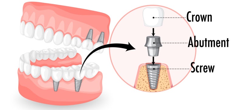 임플란트기간과 내원횟수는 얼마나 될까? 관련 이미지 5