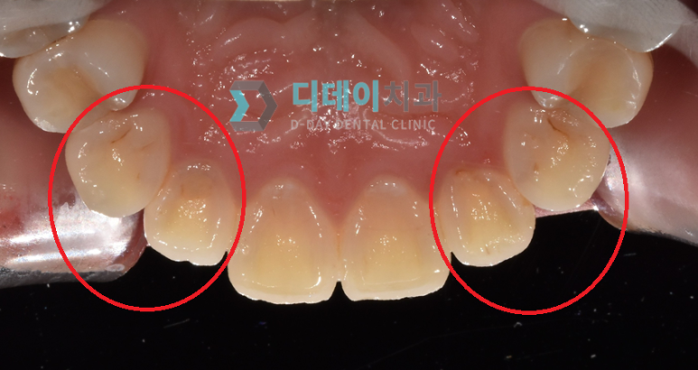 앞니살짝깨짐 이 1가지만 확인하면 치료 방향 결정됩니다 관련 이미지 3