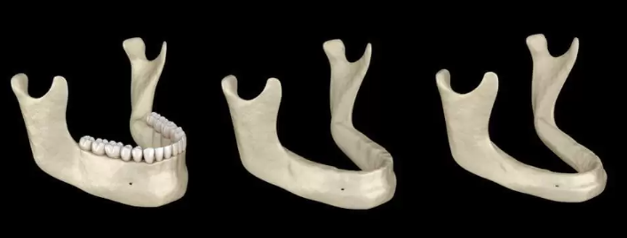 40대 전체 임플란트, 아직 젊은데 치아를 전부 발치해야만 하는 걸까? 관련 이미지 9